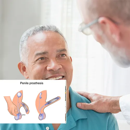 Quality of Life Enhanced by Penile Implant Solutions